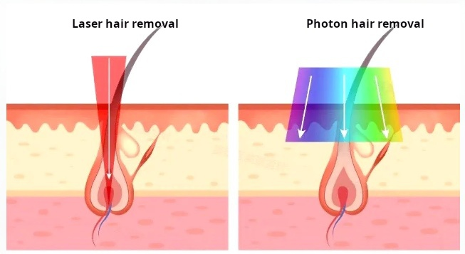 The differences of laser hair removal and photon hair removal
